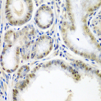 Immunohistochemistry of paraffin-embedded Human liver damage using CARD11 Polyclonal Antibody at dilution of 1:100 (40x lens).