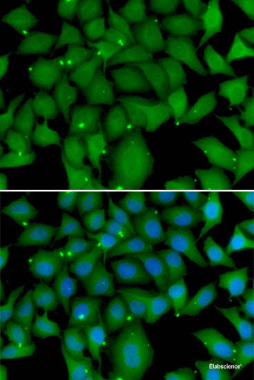 Immunohistochemistry of paraffin-embedded Human prostate cancer using PEX14 Polyclonal Antibody at dilution of 1:100 (40x lens).