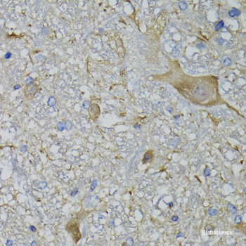 Immunohistochemistry of paraffin-embedded Human brain cancer using RUFY2 Polyclonal Antibody at dilution of 1:100 (40x lens).
