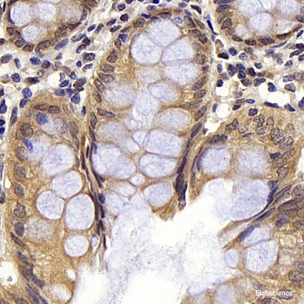 Immunohistochemistry analysis of paraffin-embedded human lung cancer using FOXO1 Polyclonal Antibody at dilution of 1:300.