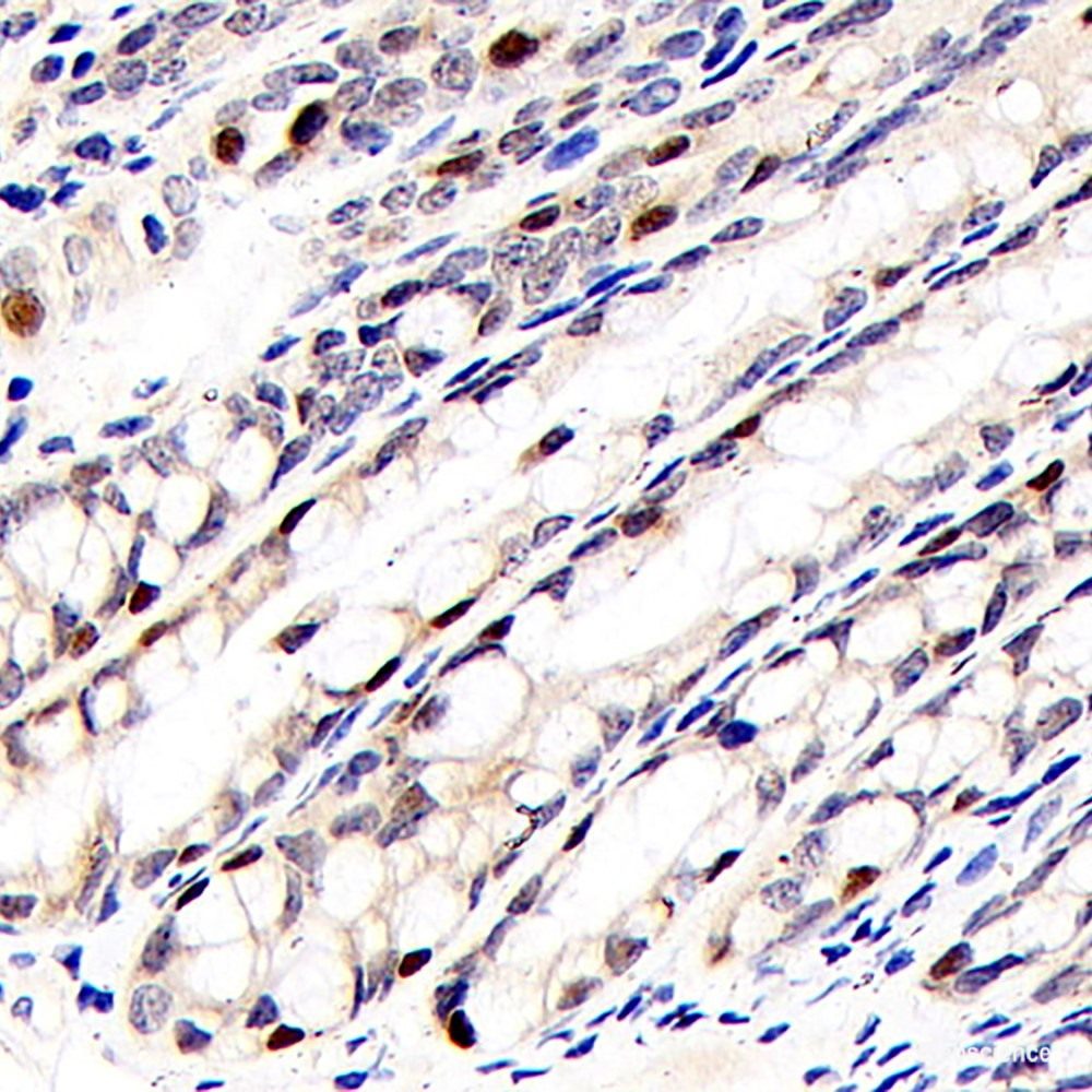 Immunohistochemistry analysis of paraffin-embedded Human hysteromyoma using VWF Polyclonal Antibody at dilution of 1:300.