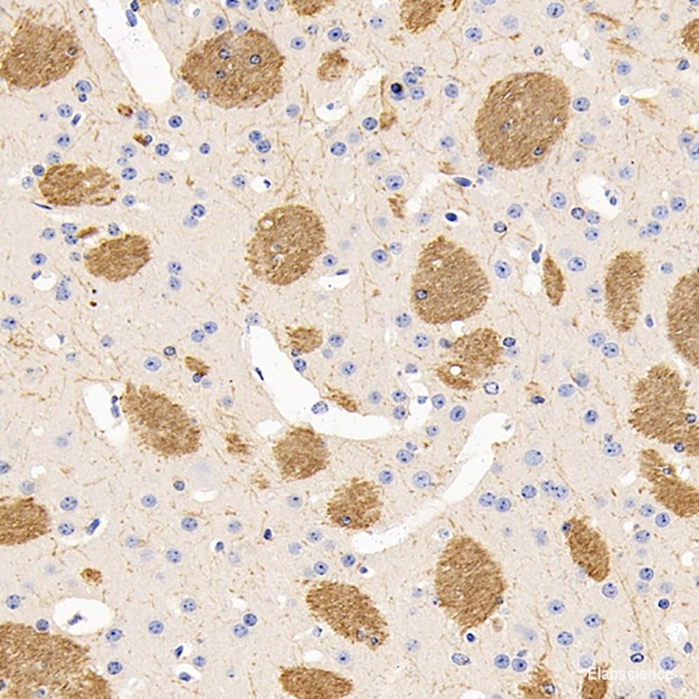 Immunohistochemistry analysis of paraffin-embedded Human lung cancer using P38 Polyclonal Antibody at dilution of 1:500.