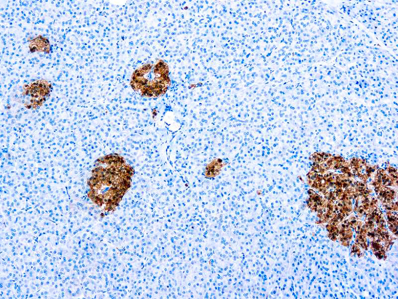 Neuron Specific Enolase