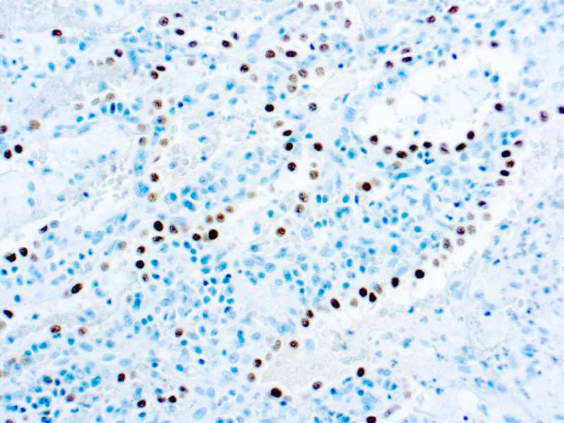 TTF-1 (Thyroid Transcription Factor-1)