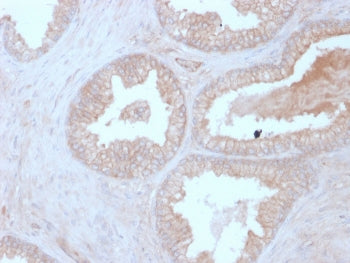 IHC staining of FFPE human prostate carcinoma with PPP3R1 antibody (clone CALNB/2342). HIER: boil ti