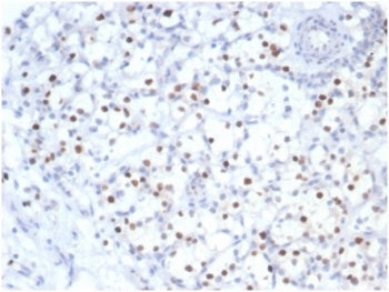 IHC staining of FFPE human kidney cancer tissue with recombinant p57Kip2 antibody (clone KIP2/7083R)
