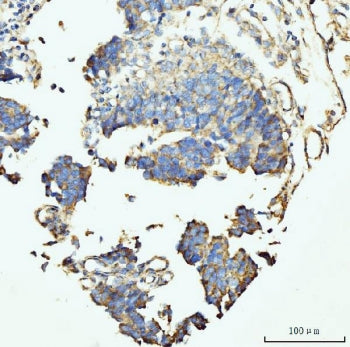 IHC staining of FFPE human colonic adenocarcinoma tissue with GRPEL1 antibody. HIER: boil tissue sec