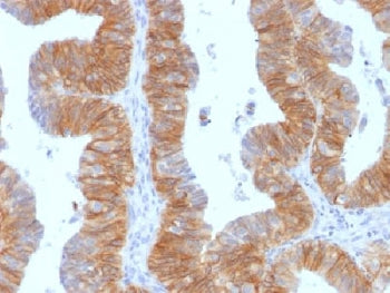 IHC testing of FFPE human ovarian carcinoma and EpCAM antibody (clone EGP40/1384). Required HIER: st