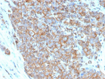 IHC staining of FFPE human urothelial carcinoma with CD33 antibody (clone SIGLEC3/3600). HIER: boil 
