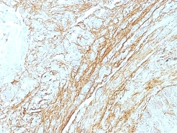 IHC: Formalin-fixed, paraffin-embedded human lung carcinoma stained with Tenascin C antibody (T2H5) 