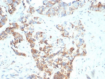 IHC staining of FFPE human gastric carcinoma with TNFRSF17 antibody (clone BCMA/7253). HIER: boil ti