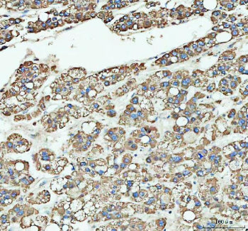 IHC staining of FFPE human liver cancer tissue with ARHGEF12 antibody, HRP-labeled secondary and DAB substrate. HIER: boil tissue sections in pH8 EDTA for 20 min and allow to cool before testing.