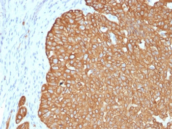 IHC staining of FFPE human basal cell carcinoma with recombinant Cytokeratin 5 antibody (clone KRT5/