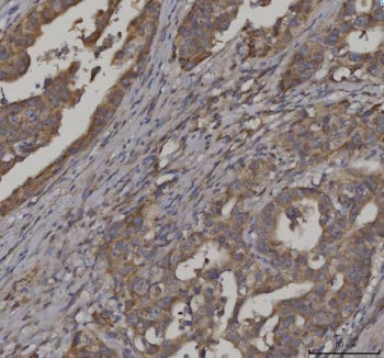 IHC staining of FFPE human colorectal adenocarcinoma tissue with FATP-3 antibody. HIER: boil tissue 