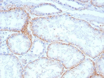 IHC staining of FFPE human renal cell carcinoma tissue with HAb18G antibody (clone BSG/7957). HIER: 