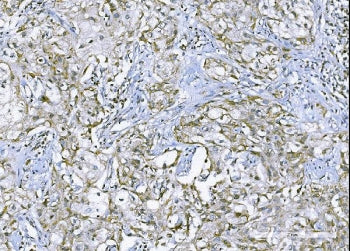 IHC staining of FFPE human B lymphocytic tumor tissue with TNF alpha antibody. HIER: boil tissue sec