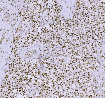 IHC staining of FFPE human testicular cancer tissue with Synaptonemal Complex Protein 3 antibody. HI