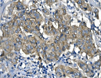 IHC staining of FFPE human breast cancer with RENT1 antibody. HIER: boil tissue sections in pH8 EDTA