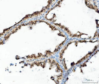 IHC staining of FFPE human ovarian cancer tissue with UBA6 antibody. HIER: boil tissue sections in p