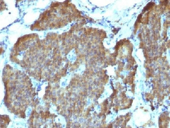 IHC testing of FFPE human pheochromocytoma with NSE antibody (clone SPM347). Required HIER: boil sec