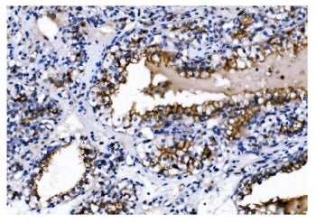 IHC staining of FFPE human renal clear cell carcinoma tissue with CD13 antibody. HIER: boil tissue s