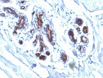 IHC analysis of formalin-fixed, paraffin-embedded human breast carcinoma stained with Lactadherin an