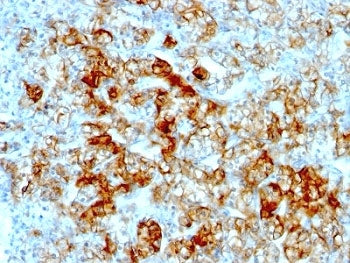 IHC: Formalin-fixed, paraffin-embedded human renal cell carcinoma stained with anti-Cadherin 16 anti