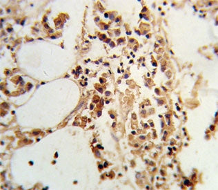 IHC testing of FFPE human breast carcinoma tissue with TIMP3 antibody. HIER: steam section in pH6 ci