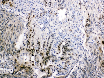 IHC testing of FFPE human intestinal cancer tissue with FABP2 antibody at 1ug/ml. Required HIER: ste
