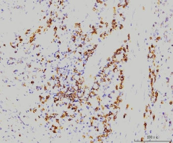 IHC staining of FFPE human gastric carcinoma tissue with RAB11A antibody. HIER: boil tissue sections