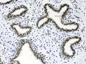 IHC testing of FFPE human breast cancer tissue with Musashi antibody at 1ug/ml. Required HIER: steam