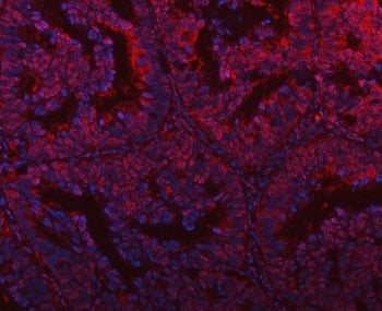 Immunofluorescent staining of FFPE human intestinal cancer tissue with PLEKHG5 antibody (red) and DA