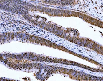 IHC staining of FFPE human colorectal adenocarcinoma tissue with ZMYND8 antibody. HIER: boil tissue 