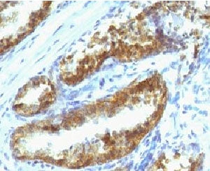 IHC testing of human prostate carcinoma with Prostate Specific antibody (clone PSAK3-1). Staining of