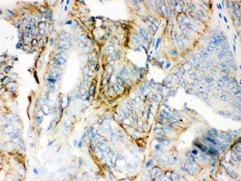 IHC testing of FFPE human intestinal cancer with PKLR antibody. HIER: Boil the paraffin sections in 