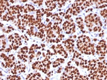 IHC testing of FFPE human prostate carcinoma with FOXA1 antibody (clone FOXA1/1512). HIER: boil sect