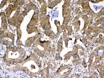 IHC testing of FFPE human rectal cancer tissue with PPID antibody at 1ug/ml. Required HIER: steam se