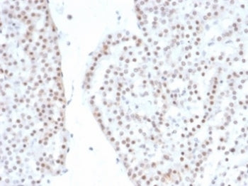 IHC staining of FFPE human renal oncocytoma with recombinant SF-1 antibody (clone NR5A1/4368R). HIER