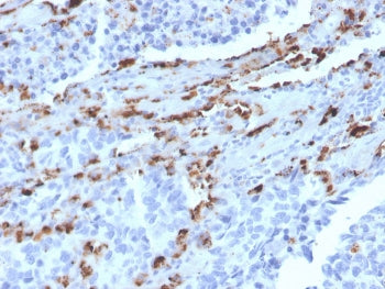 IHC staining of FFPE human lung adenocarcinoma with Napsin A antibody (clone NAPSA/3309). HIER: boil