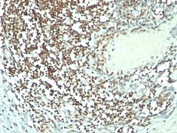 IHC: Formalin-fixed, paraffin-embedded human bladder carcinoma stained with Nucleolin antibody (364-