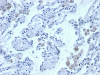 IHC staining of FFPE human lung with Cystatin B antibody. HIER: boil tissue sections in pH 9 10mM Tr