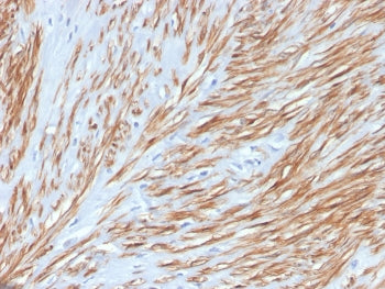 IHC staining of FFPE human leiomyosarcoma with recombinant CNN1 antibody. HIER: boil tissue sections