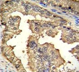 IHC testing of PRMT4 antibody and FFPE human prostate carcinoma.