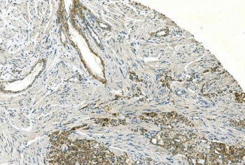 IHC staining of FFPE human renal carcinoma with Cadherin 13 antibody. HIER: boil tissue sections in 