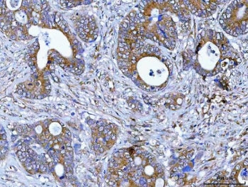 IHC staining of FFPE human colorectal adenocarcinoma tissue with PDXDC1 antibody. HIER: boil tissue 