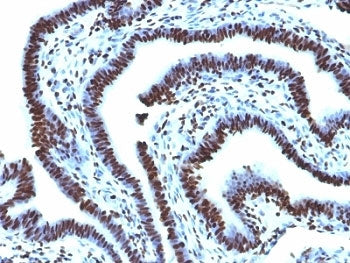 IHC: Formalin-fixed, paraffin-embedded human ovarian carcinoma stained with Histone H1 antibody (AE-