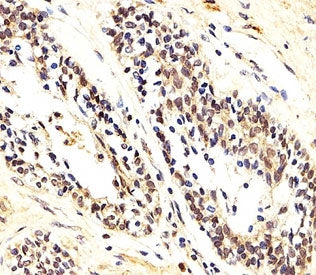 IHC analysis of FFPE human prostate carcinoma section using AKT1/2/3 antibody; Ab was diluted at 1:2
