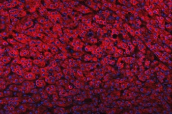 Immunofluorescent staining of FFPE human liver cancer tissue with Delta-5 desaturase antibody (red) 