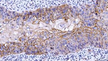 IHC staining of FFPE human laryngeal squamous cell carcinoma tissue with CD55 antibody. HIER: boil t