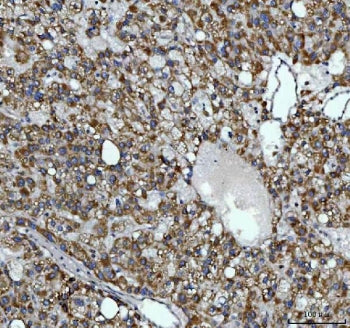 IHC staining of FFPE human liver cancer tissue with Alkyl-DHAP synthase antibody. HIER: boil tissue 